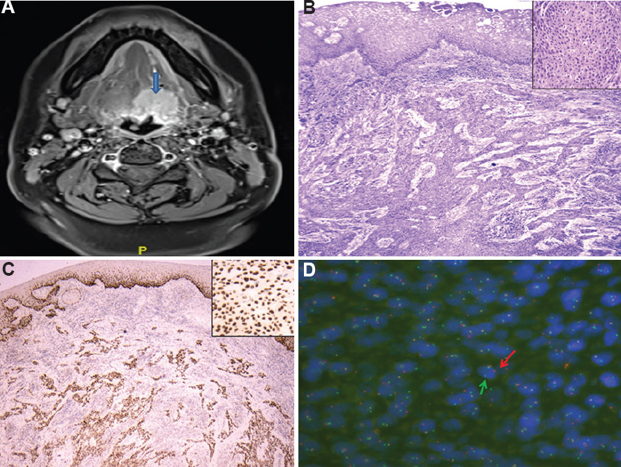 (A) Magnetic resonance imaging neck showing a non-circumscribed lesion in the posterior third of tongue on left involving the base of the tongue, extending to the floor of the mouth (blue arrow). (B) Histology shows an unencapsulated tumour composed of cells arranged as irregular cords and nests separated by hyalinized stroma involving the subepithelial tissue with occasional connection to the overlying stratified squamous epithelium. Tumour cells have eosinophilic cytoplasm, round or oval nuclei with mild nuclear atypia and variably conspicous small nucleoli. Occasional mitotic figures were noted (H and E ×100, H and E ×400, inset). (C) Immunohistochemistry with p63 showing diffuse and strong nuclear positivity in the tumour cells (×100). Inset shows higher power view of p63 expression in the tumour cells (×400). (D) Fluorescence in situ hybridization using EWSR1 (22q12) dual-colour, break-apart probe showing positive results for EWS gene rearrangement [1 yellow fusion signal and 1 pair of split orange and green signals (orange-centromeric side and green-telomeric side, arrows) in most nuclei].